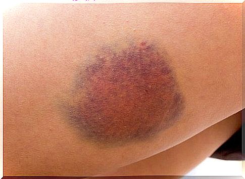 Bruise cancer