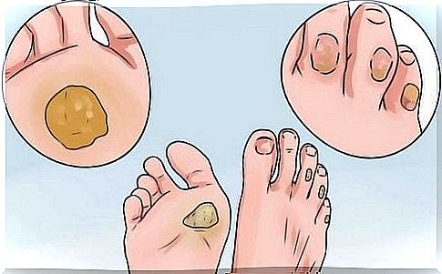 10 natural remedies to say goodbye to calluses and blisters