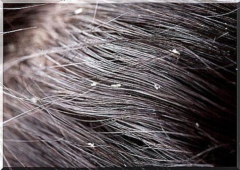 Hair with dandruff