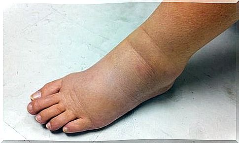 Kidney edema or inflammation