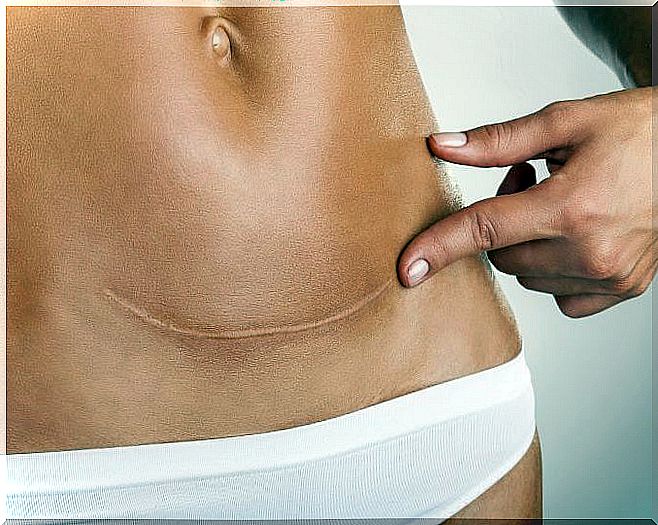 Scar in the lower abdomen