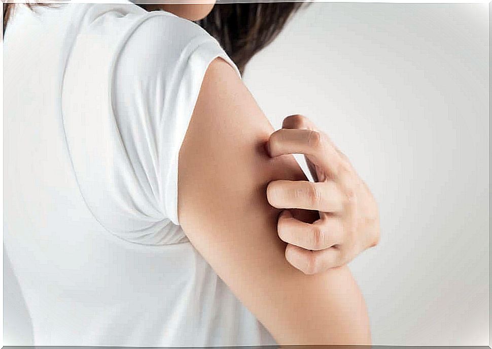 Itching caused by allopurinol