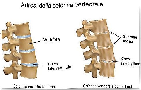 Arthrosis of the spine and healthy spine