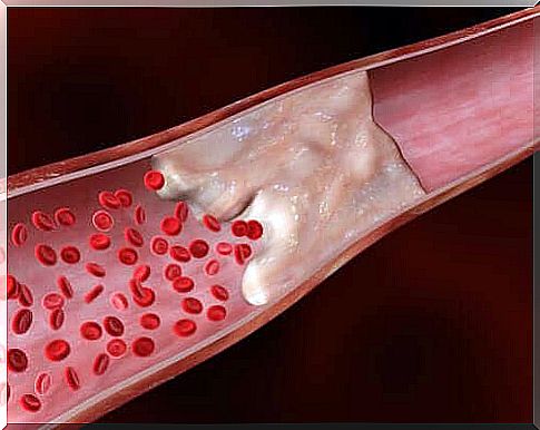 Calcium in the arteries and cardiovascular disease