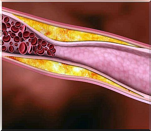 Bad cholesterol in the arteries.