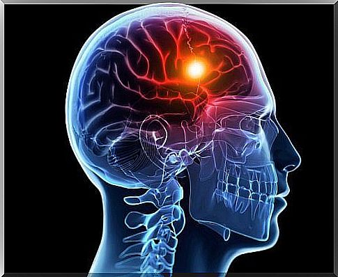 Cerebral infarction: recognize it thanks to 8 signals from the body