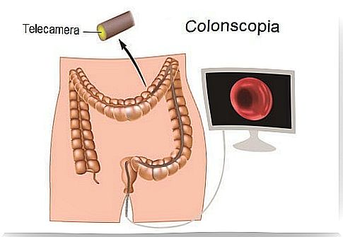 Colon cancer: how to identify it in time?