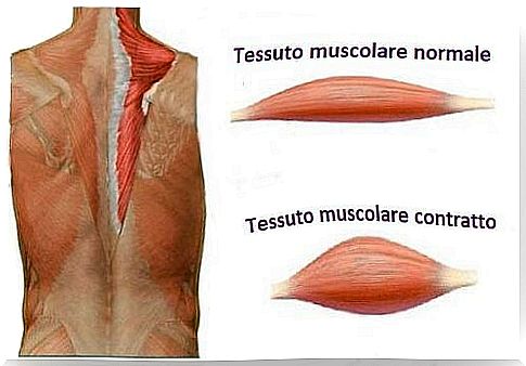 Muscle contracture