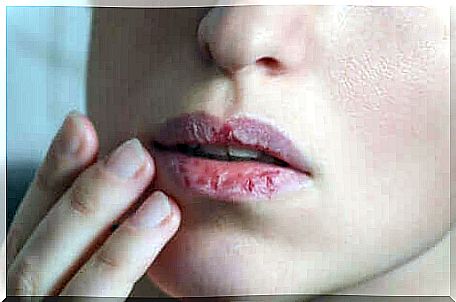 Cracked lips.