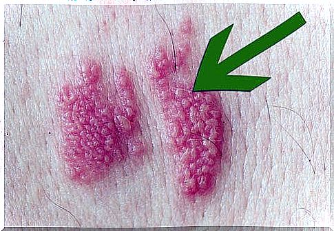 Herpes zoster: what it is and how it manifests itself