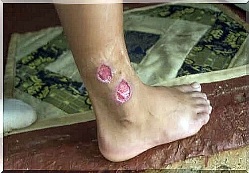 Skin leishmaniasis lesions.