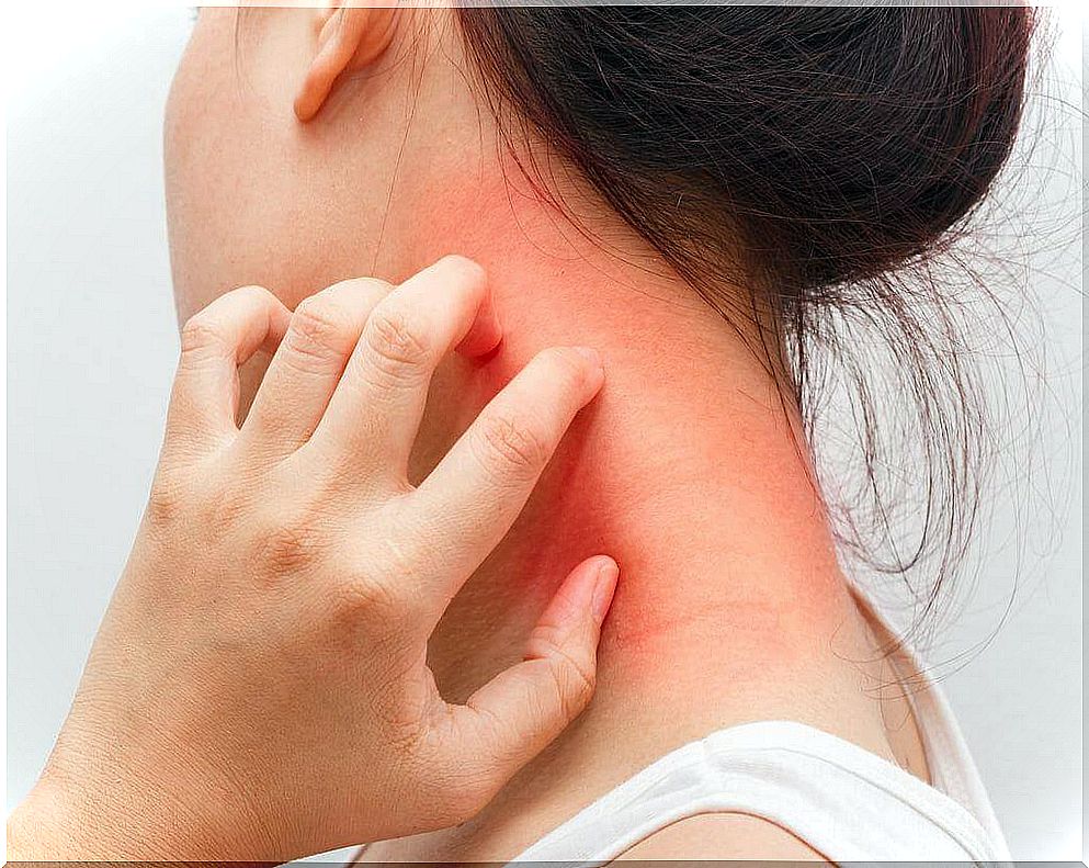 Dermatitis and irritation