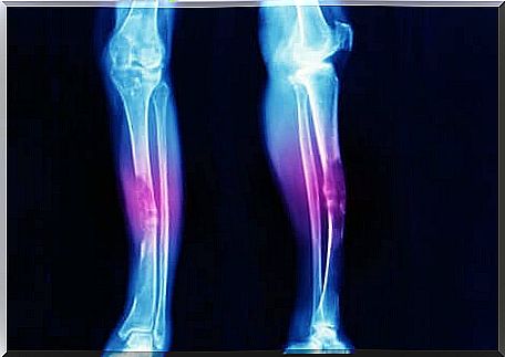 Synovial sarcoma near the joints.