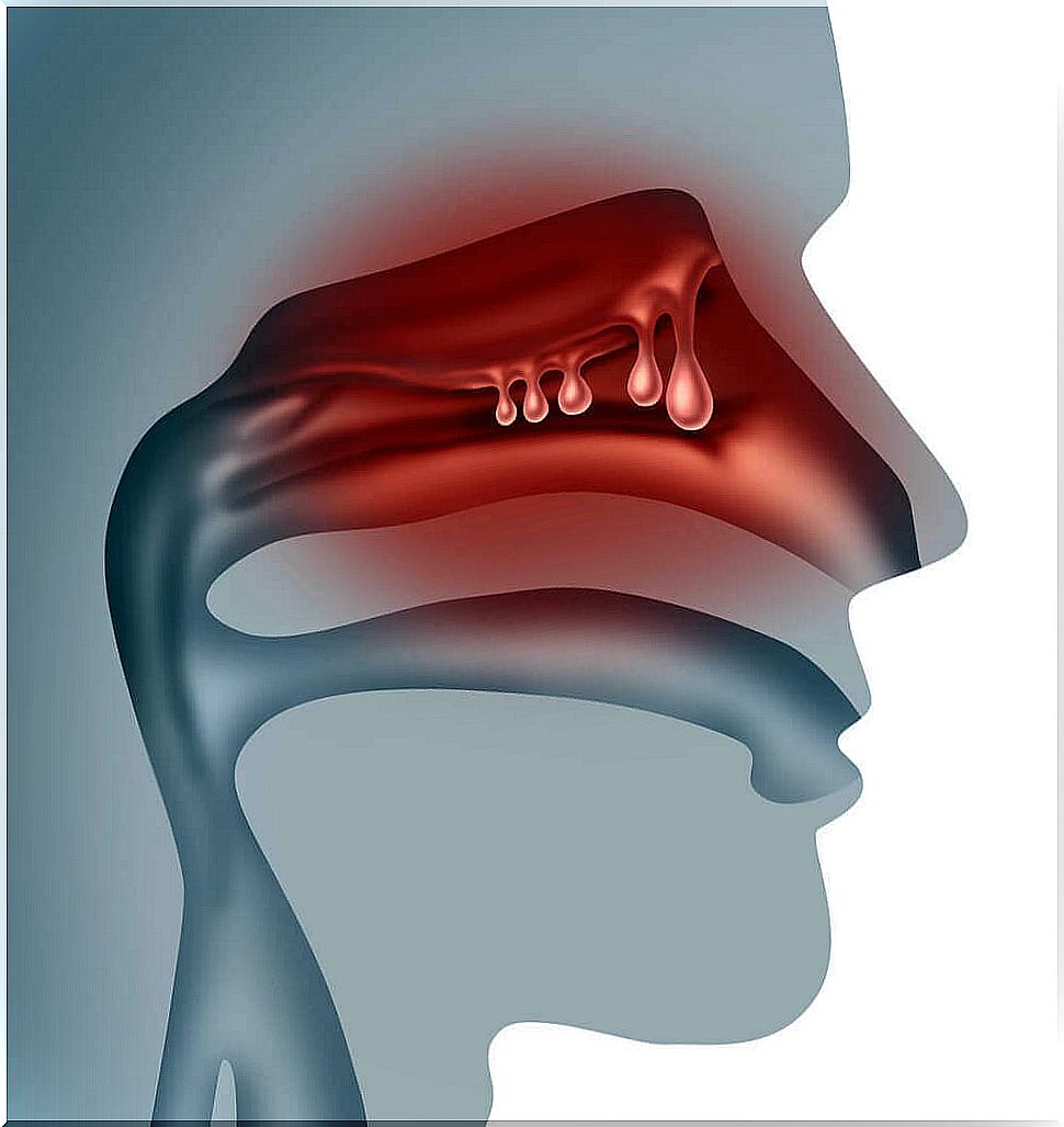 Nasal polyps.