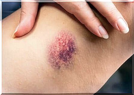 The appearance of a hematoma is among the symptoms of a superficial thrombophlebitis.