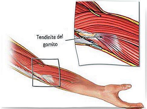 Treating elbow tendonitis