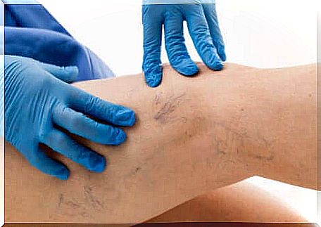 Treating varicose veins: medical checkup.