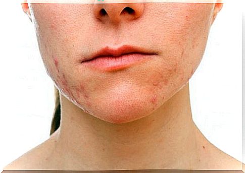 Excess stress causes inflammatory aeration which causes clogging of the skin pores