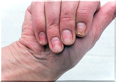 Yellow nails, natural remedy to whiten them